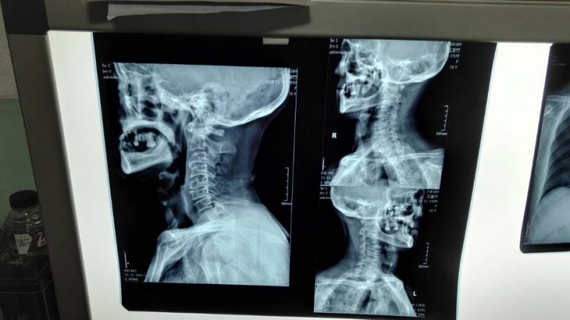 平板改裝（普通X光機(jī)升級DR）