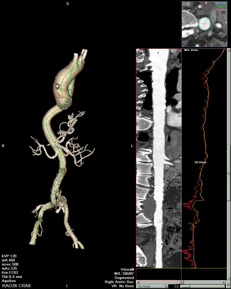 Vitrea三維影像后處理軟件