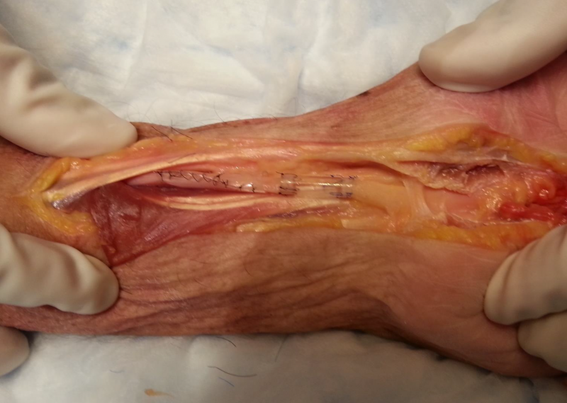 進口外周神經(jīng)導管