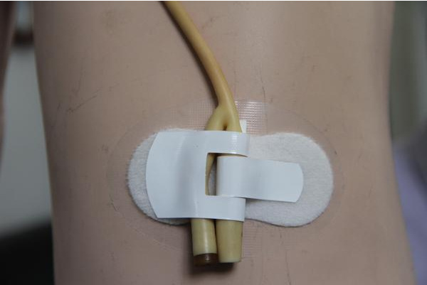 導(dǎo)尿管固定