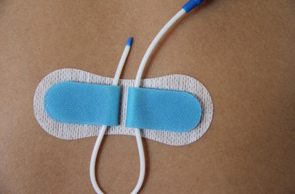 淄博創(chuàng)奇 留置針  導(dǎo)管固定裝置 新消息