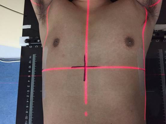 放療定位標(biāo)記線保護(hù)膜