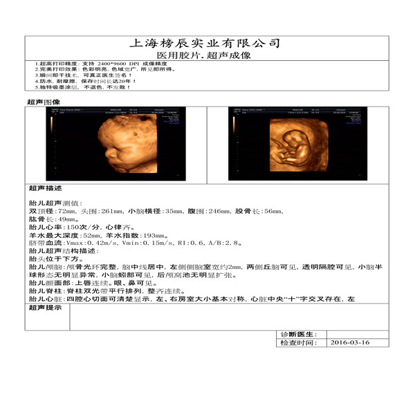 彩超a4瓷白噴墨膠片 A4醫(yī)用彩色噴墨打印防水膠片光面瓷白