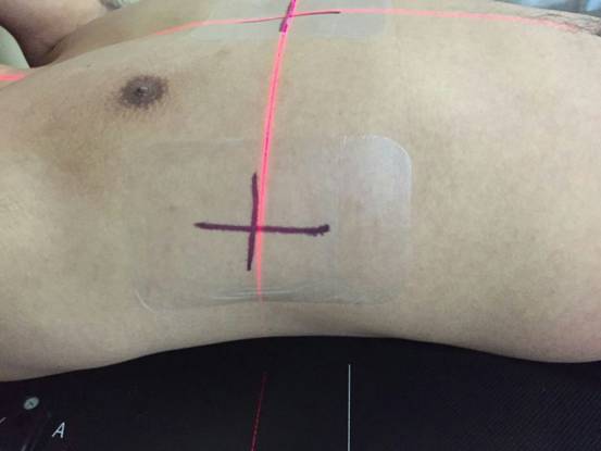 放療定位標記與保護產(chǎn)品