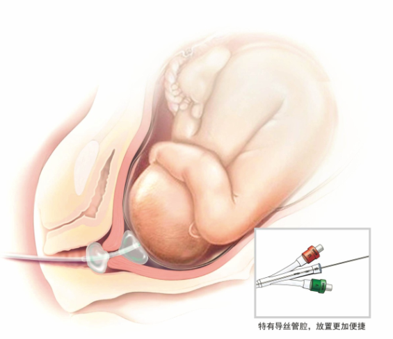 一次性使用子宮頸擴張球囊導管