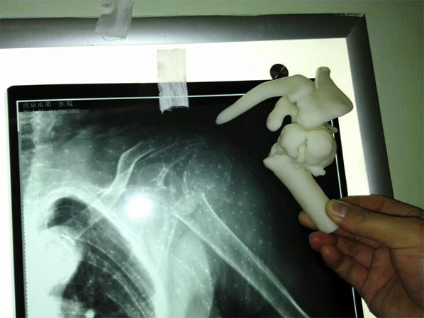 骨科新技術(shù)-3D打印手術(shù)規(guī)劃模型