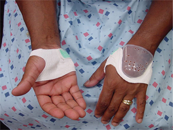 留置針輸液保護(hù)