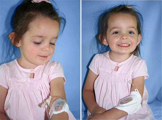 兒童輸液保護罩