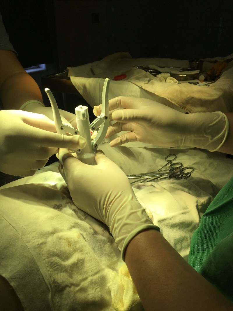 包皮吻合器  包皮切割吻合器  狼和包皮吻合器