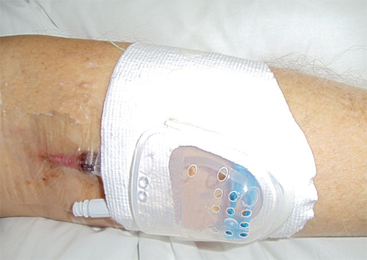 留置針保護(hù)