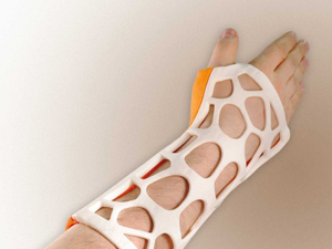 骨科新技術——3D打印手術夾板、支具