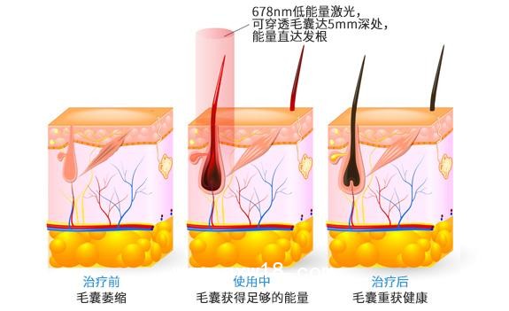 “艾博拉”半導(dǎo)體激光生發(fā)儀、全國招商代理、加盟