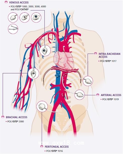 貝魯斯植入式中心靜脈導(dǎo)管