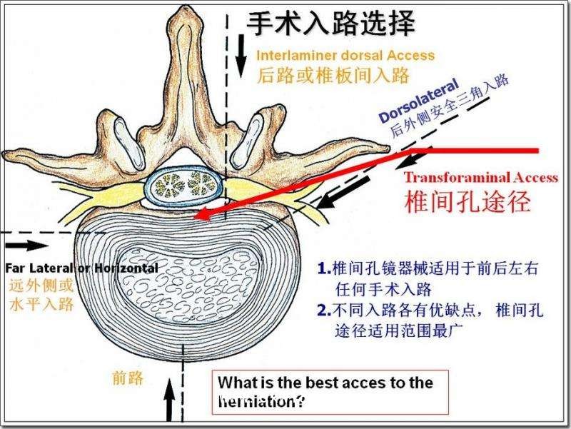 德國費格椎間孔鏡技術(shù)
