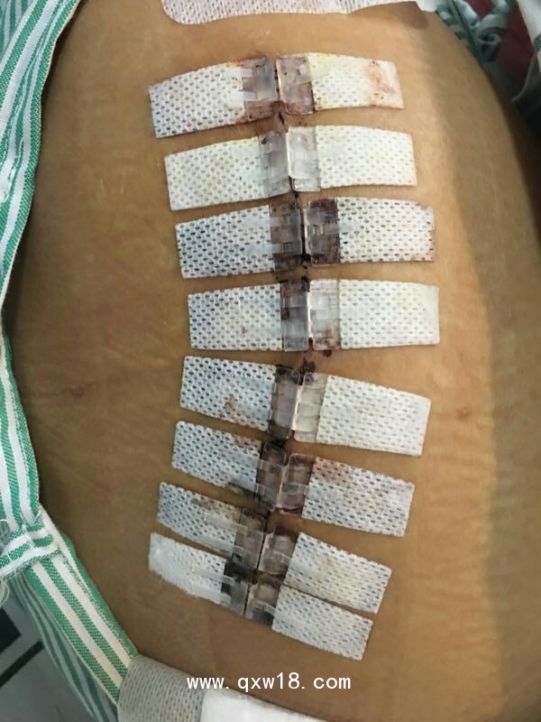 無針皮膚縫合器