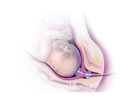 維力醫(yī)療的一次性使用子宮頸擴張球囊導(dǎo)管