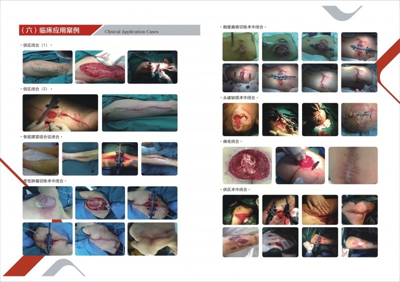 拉桿式傷口皮膚擴(kuò)展器