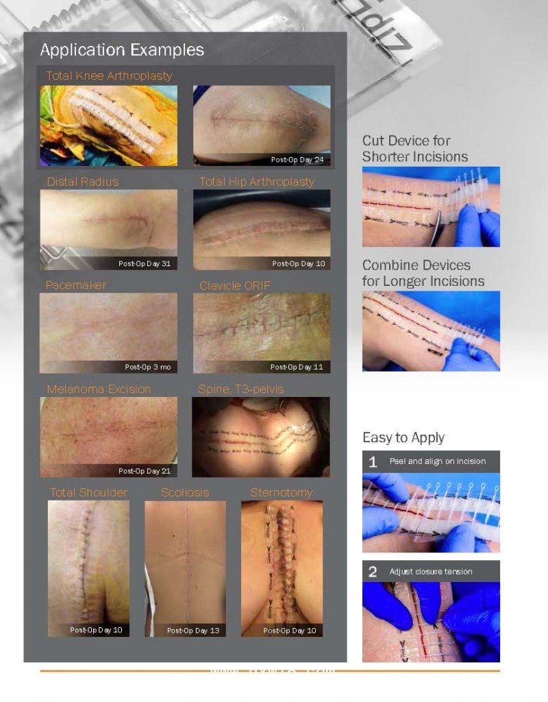 捷膚聯(lián)無創(chuàng)高強度皮膚縫合器