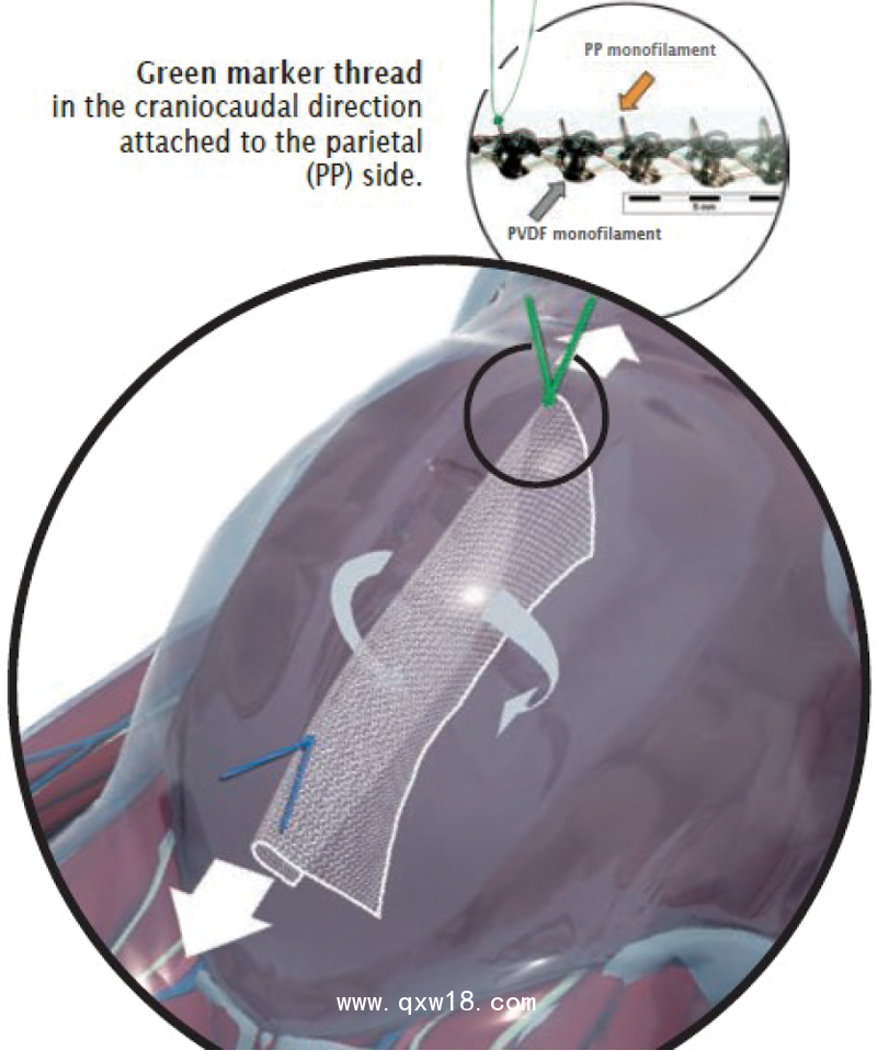 德國PVDF材質(zhì)疝氣補片-IPOM