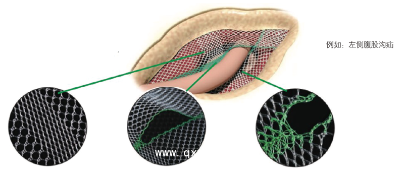 德國PVDF材質(zhì)疝氣補片-Lichtenstein