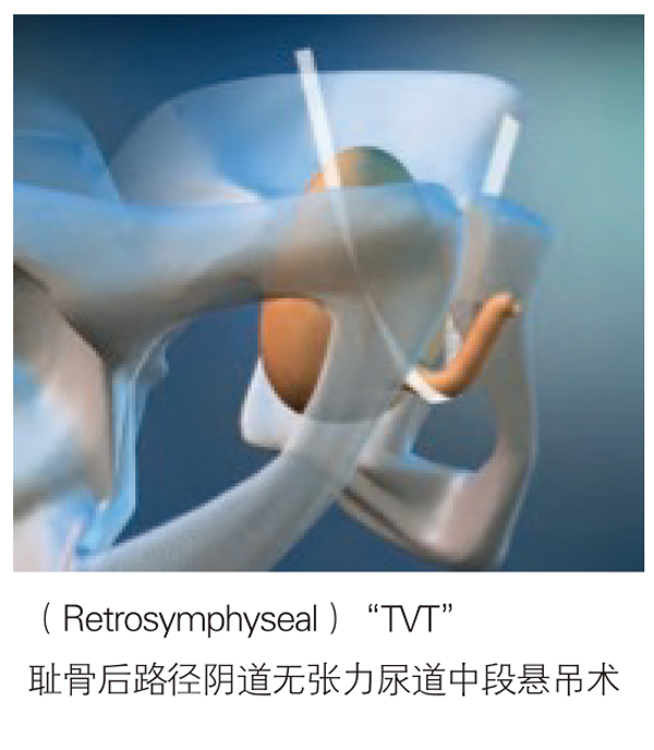 德國(guó)PVDF材質(zhì)尿失禁吊帶-SIS/SIS direct