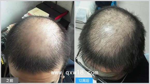 高能半導(dǎo)體激光祛脂生發(fā)儀周期多少