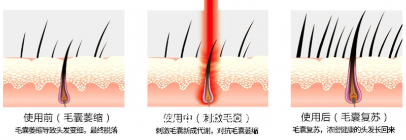 激光生發(fā)養(yǎng)發(fā)耗材代理激光生發(fā)儀（送）生發(fā)養(yǎng)發(fā)館加盟