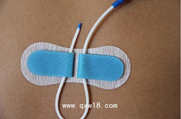 一次性導(dǎo)管固定裝置（留置針延長管、硬膜外固定裝置）