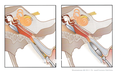 德國球囊擴張導(dǎo)管