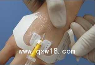 體表導(dǎo)管固定裝置