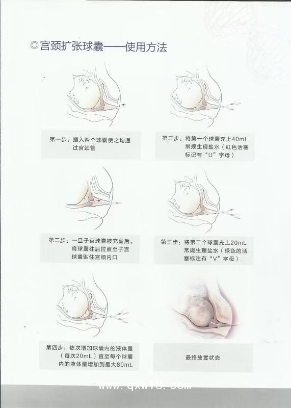 一次性子宮頸球囊導(dǎo)管引產(chǎn)包