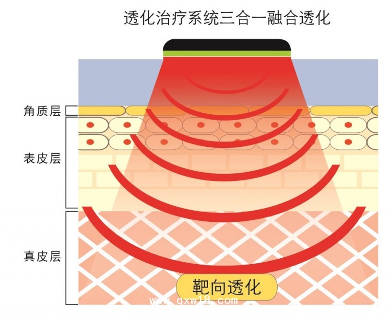 透化治療系統(tǒng)