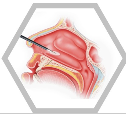 耳鼻喉等離子刀頭