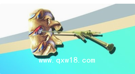 德國ASAP脊柱內窺鏡及手術器械