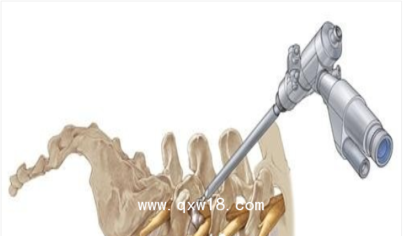 德國ASAP脊柱內(nèi)窺鏡及手術(shù)器械