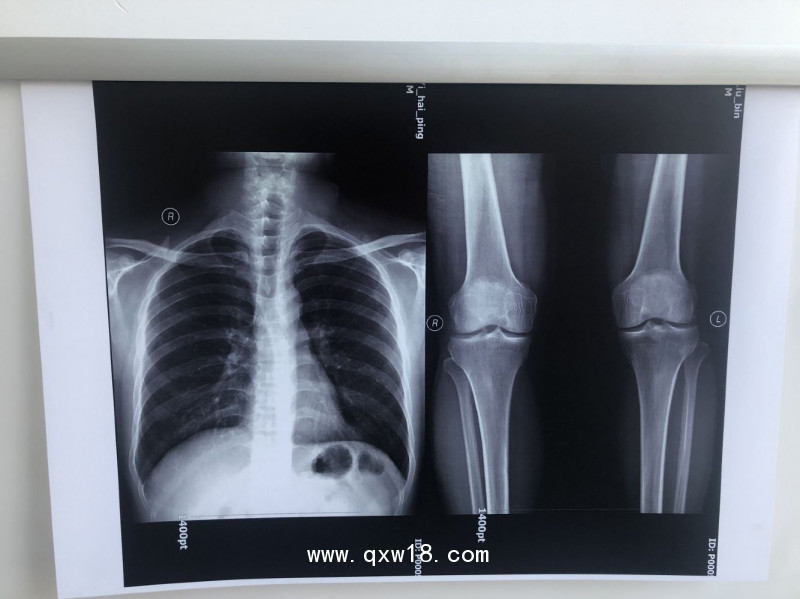 【奧格西】國產(chǎn)激光醫(yī)用膠片（三維彩超）