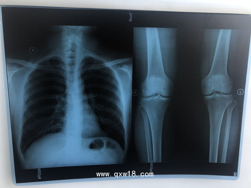 【奧格西】國產(chǎn)激光醫(yī)用膠片（三維彩超）