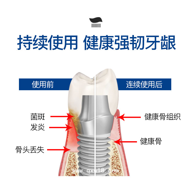 國內(nèi)首支鈦舒鎂種植牙專用護理牙膏