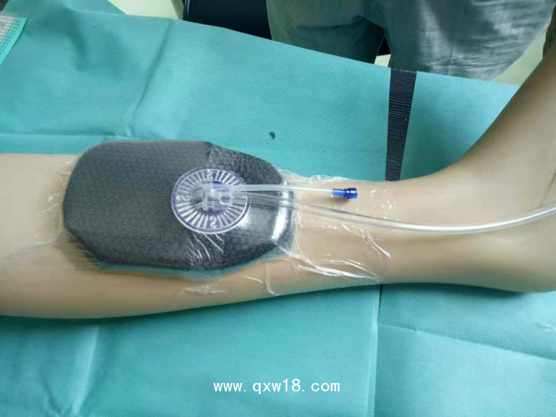 一次性負(fù)壓引流護(hù)創(chuàng)材料 獨(dú)立吸盤式