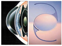 眼力健人工晶體