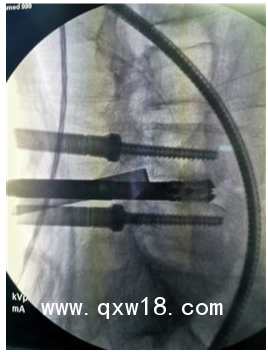 UBE器械、UBE技術(shù)