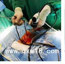 UBE器械、UBE技術(shù)