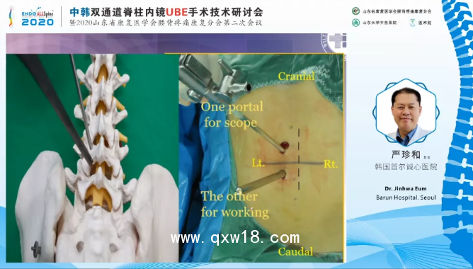 UBE全套脊柱手術(shù)器械 BESS/UBE全脊柱內(nèi)窺鏡手術(shù)器械