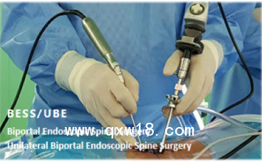 奧蘇本全套手術(shù)器械 UBE耗材 UBE培訓(xùn) UBE腰椎狹窄