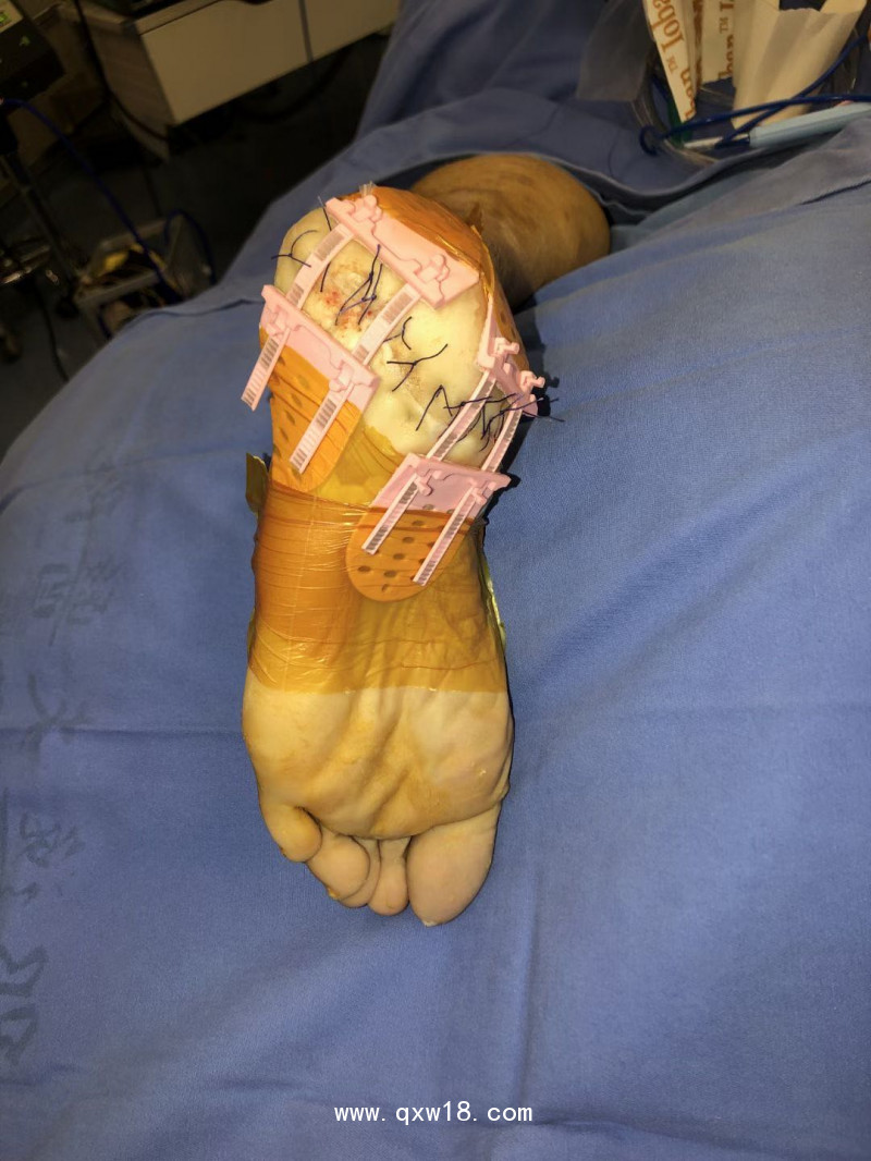 醫(yī)用皮膚減張閉合器