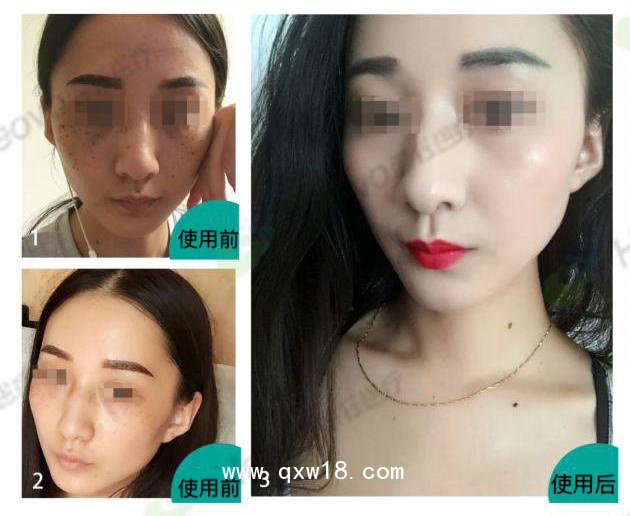 美拉美尚干細(xì)胞外泌體液體敷料