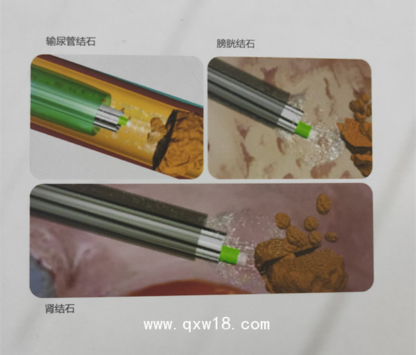 廣州萬瑪醫(yī)療科技有限公司提供維力一次性使用清石鞘