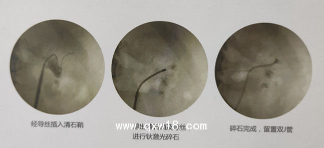 廣州萬瑪醫(yī)療科技有限公司提供維力一次性使用清石鞘