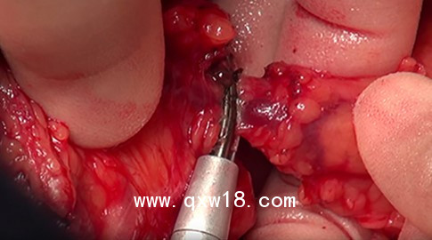 強(qiáng)生超聲刀頭har9f 甲狀腺刀頭 乳腺刀頭