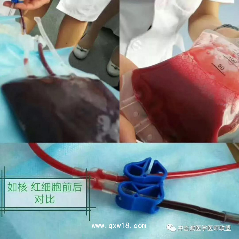 臭氧自體血血袋、三氧自體血血袋、一次性血袋